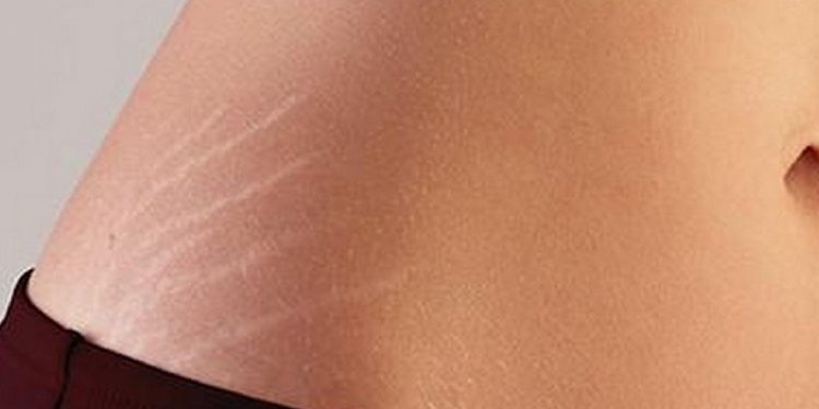 Las estrías, un problema