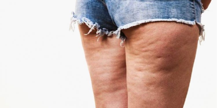 Celulitis: Cómo prevenir y combatir