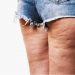 Celulitis: Cómo prevenir y combatir