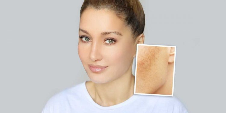 Consejos para eliminar las manchas en la piel