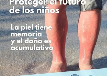 Médicos alertan por época crítica de quemaduras en niños