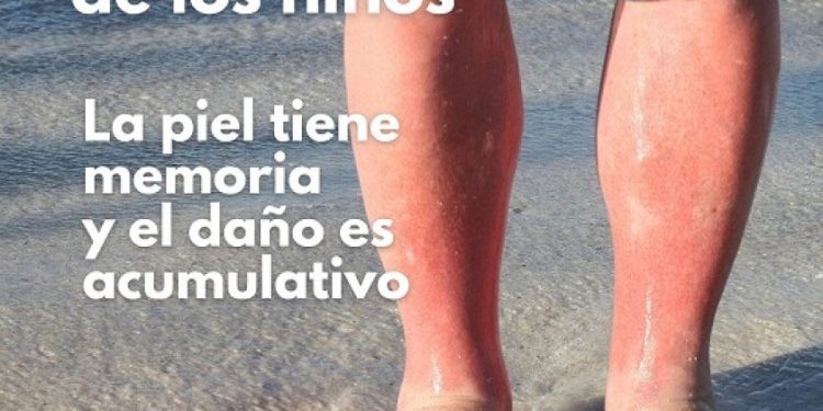 Médicos alertan por época crítica de quemaduras en niños