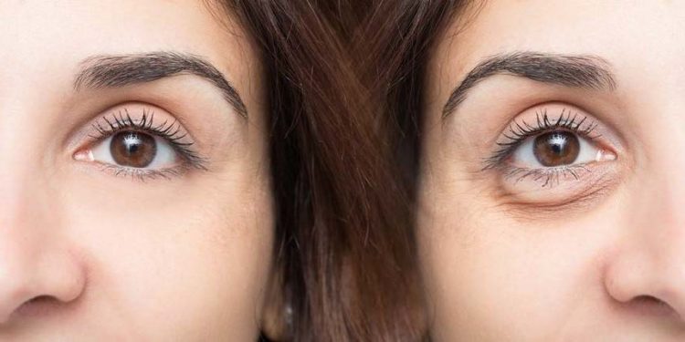 Trucos para eliminar las ojeras y las bolsas de los ojos